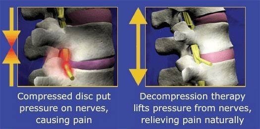 compressed disc and decompression therapy